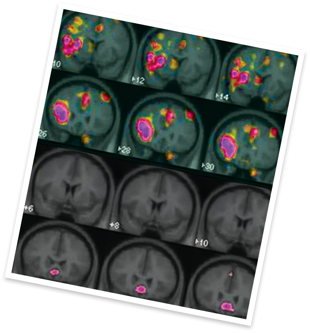 HSDD vs. normal female brain scan Addyi® (flibanserin)